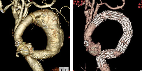 胸部下行大動脈瘤に対するステントグラフト