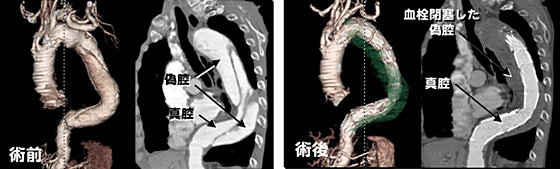 解離性大動脈瘤に対するステントグラフト