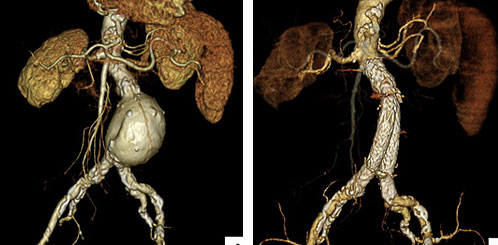 腹部大動脈瘤に対するステントグラフト